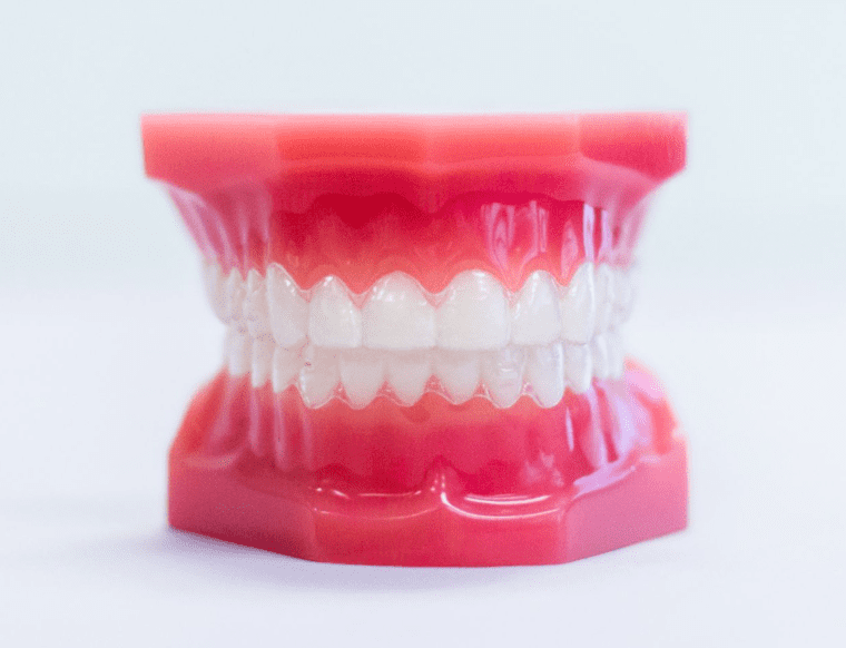 Clear Aligners