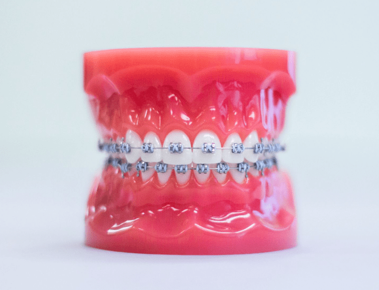 Traditional Braces